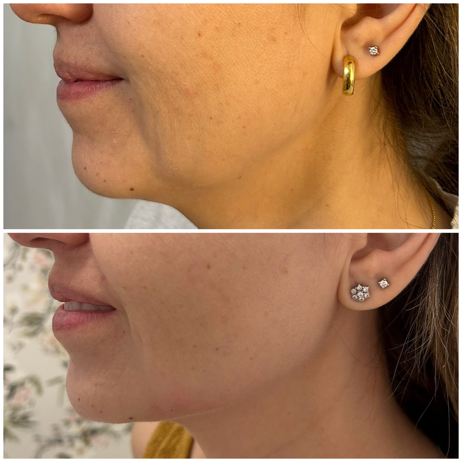 Caso real de armonización facial y definición del arco mandibular en Valencia
