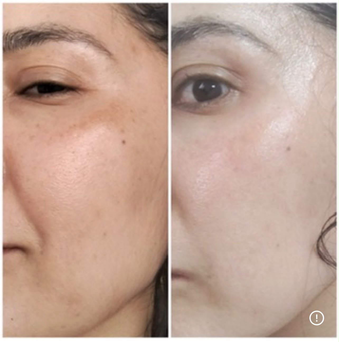 Caso real de tratamiento de manchas y despigmentación facial en Valencia
